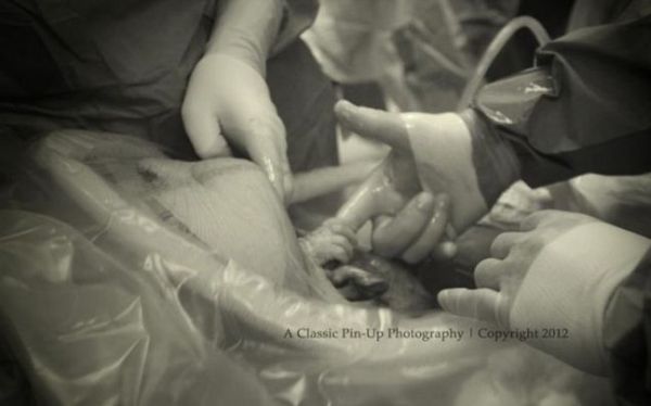 Αγέννητο μωρό αρπάζει το δάχτυλο του γιατρού