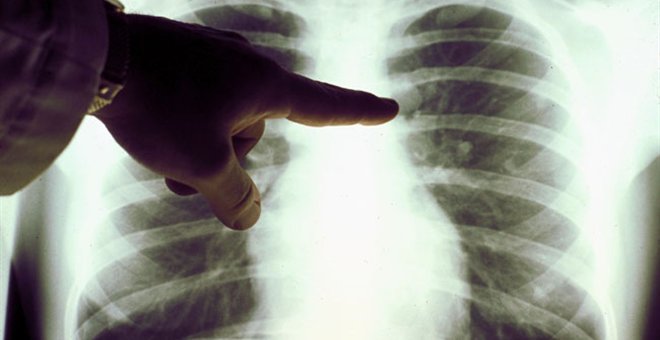 Η αξονική τομογραφία στους πνεύμονες μπορεί να προλάβει τον καρκίνο