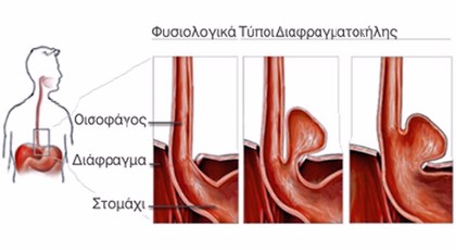 Η διαφραγματοκήλη