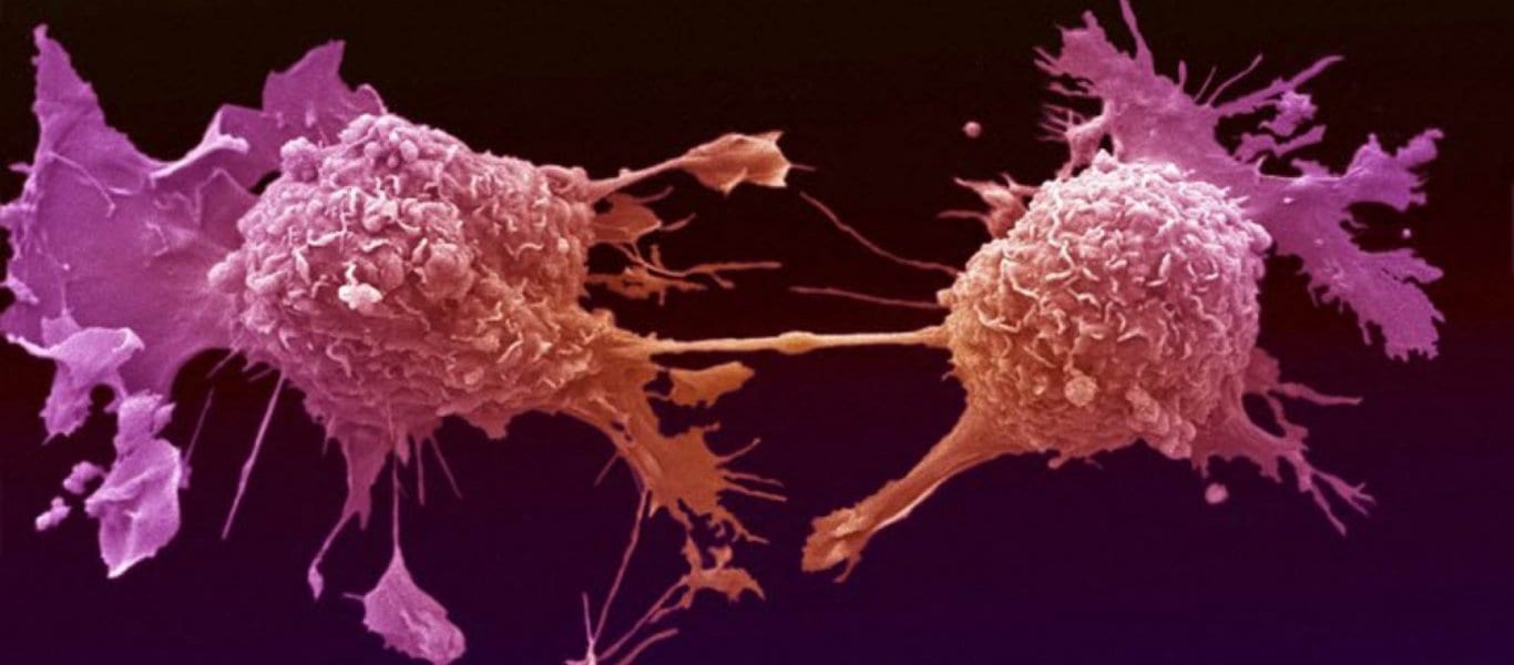 Οι δύο αλλαγές στη ζωή σας που θα κρατήσουν μακριά τον καρκίνο