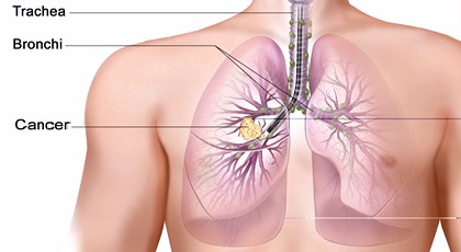 Νέα θεραπεία γι’ αυτούς που έχουν προσβληθεί από καρκίνο του πνεύμονα