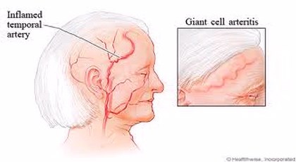 Η κροταφική αρτηρίτιδα