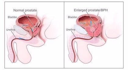 Η καλοήθης υπερπλασία του προστάτη