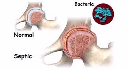 Η σηπτική αρθρίτιδα