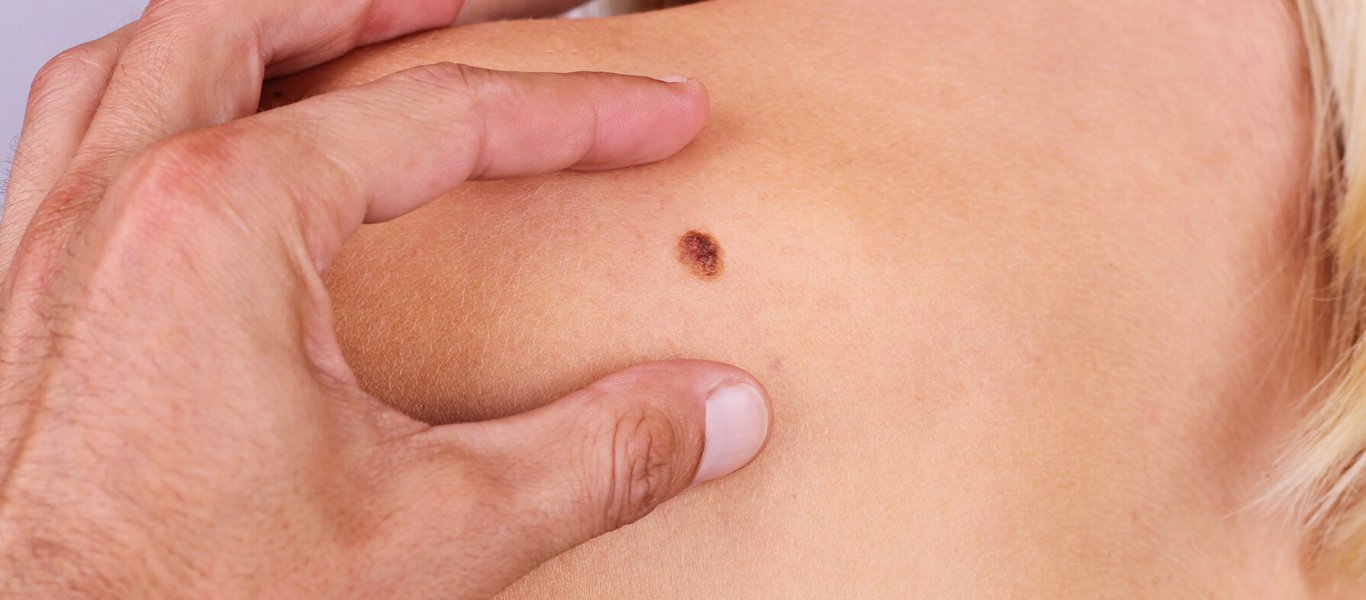 Ελιές στο δέρμα: Πότε πρέπει να ανησυχήσετε για εμφάνιση καρκίνου