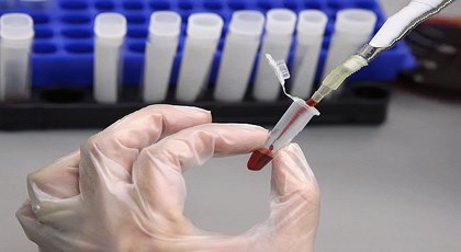 Νέο τεστ αίματος ανιχνεύει με ακρίβεια το σύνδρομο Down