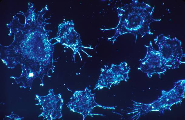 Φρένο στον καρκίνο με “ανατίναξη” καρκινικών κυττάρων