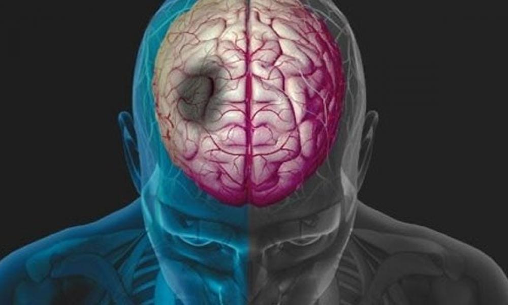Όγκος στον εγκέφαλο: Ποιά είναι τα προειδοποιητικά σημάδια (Βίντεο)