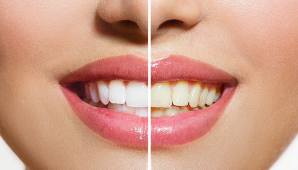 Κάντε φυσική λεύκανση στα δόντια σας χωρίς γιατρούς και οδοντόκρεμες!