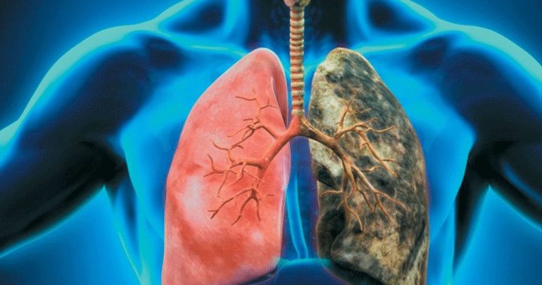 Πρόγραμμα Προληπτικού Ελέγχου «Πνευμόνων Υγεία» δυναμικά στη μάχη κατά του καρκίνου του πνεύμονα
