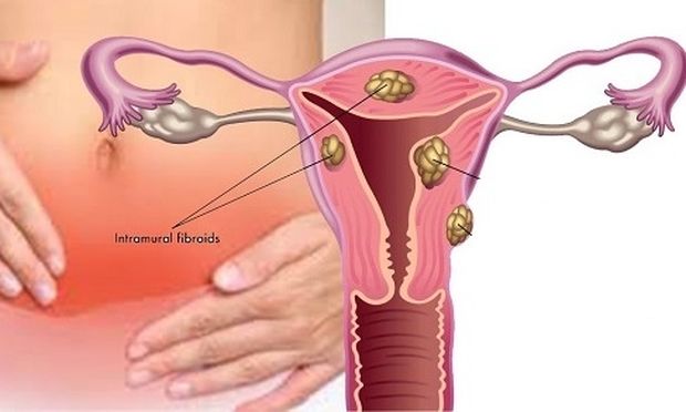 Είναι τα ινομυώματα απειλή για τη γυναικεία γονιμότητα;