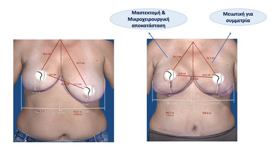 Αποκατάσταση μαστού και επίτευξη συμμετρίας σε ένα χειρουργείο με τη βοήθεια της τρισδιάστατης απεικόνισης
