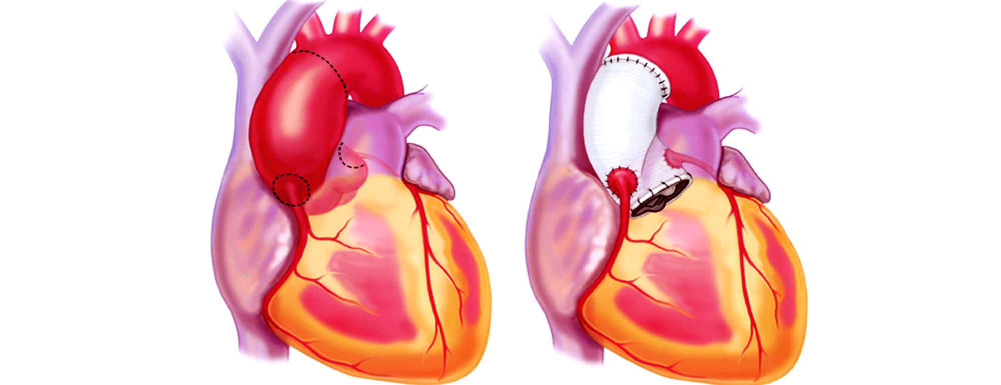 Τι είναι το ανεύρυσμα καρδιάς; Που οφείλεται;