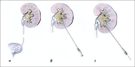 Μίνι-Διαδερμική Νεφρολιθοτριψία: Η τεχνολογία στην υπηρεσία της ουρολογίας