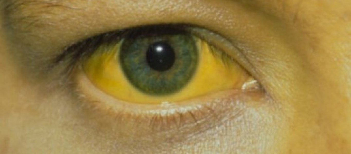Ίκτερος: Γιατί κιτρινίζει το δέρμα και τα μάτια; Με ποιές ασθένειες συνδέεται;