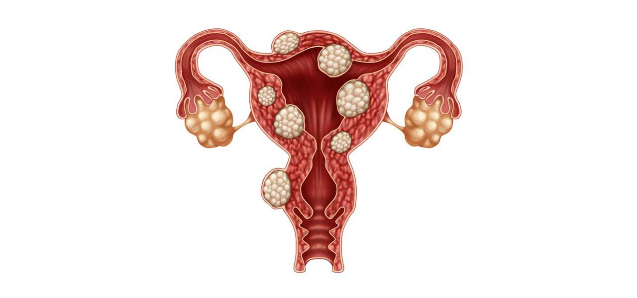Эндометрия узлов. Яичники у женщин. Злокачественные заболевания яичников.