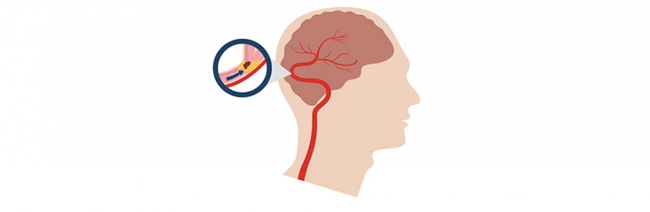 Θρομβεκτομή: Ένα άλμα στη θεραπεία του Ισχαιμικού Εγκεφαλικού Επεισοδίου