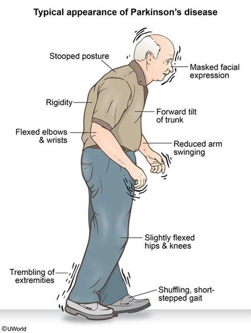 Νόσος Parkinson την εποχή του κορωνοϊου