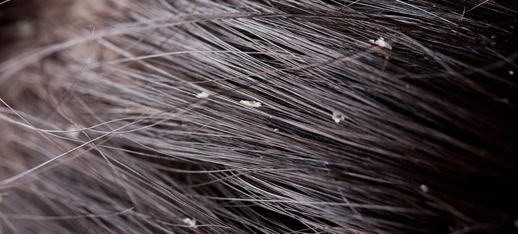 Τι μπορεί να σημαίνει για την υγεία η πιτυρίδα στα μαλλιά;