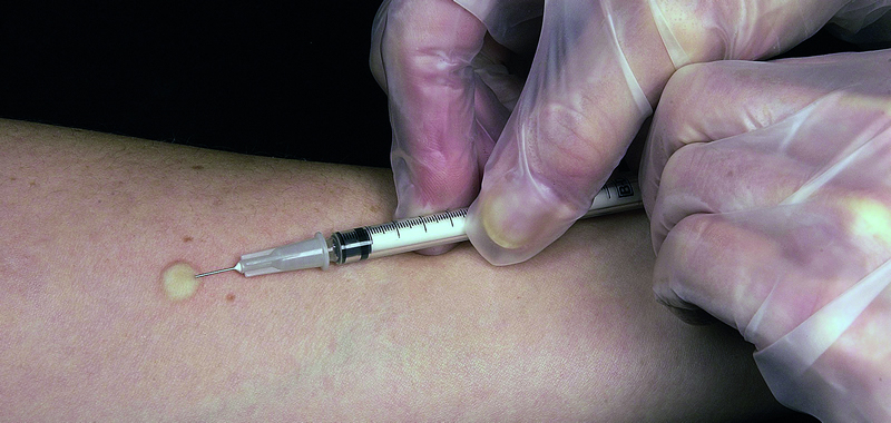 QuantiFERON VS Mantoux: Ενδείξεις και χρησιμότητα