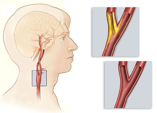 Καρωτιδική νόσος – Αγγειακά εγκεφαλικά επεισόδια