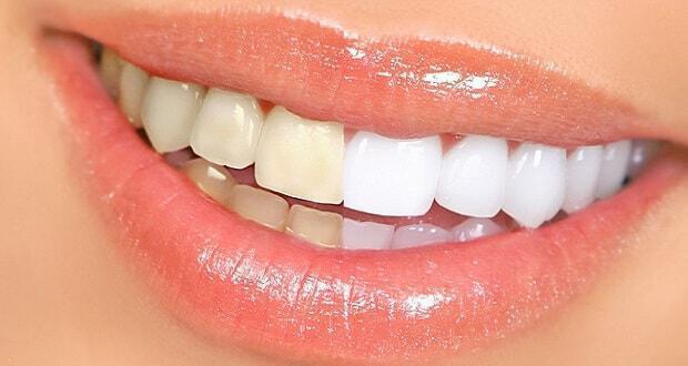 Ποιές τροφές κιτρινίζουν τα δόντια; Πώς να τα επαναφέρετε