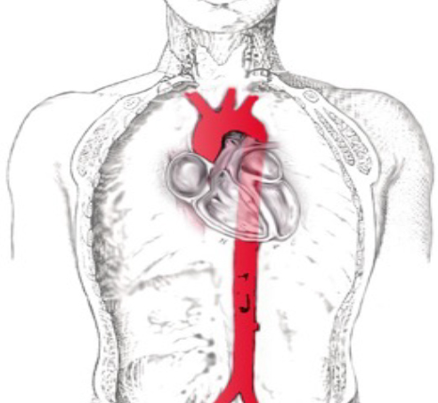Ανεύρυσμα θωρακικής αορτής: Όλα όσα πρέπει να γνωρίζετε