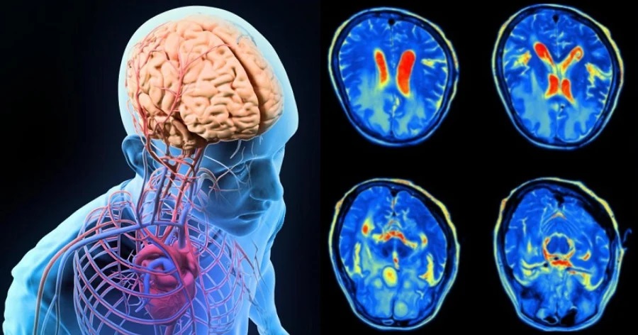 Η επίπτωση τα κλινικά χαρακτηριστικά και η έκβαση ασθενών με εγκεφαλίτιδα σχετιζόμενη με τη νόσο COVID-19