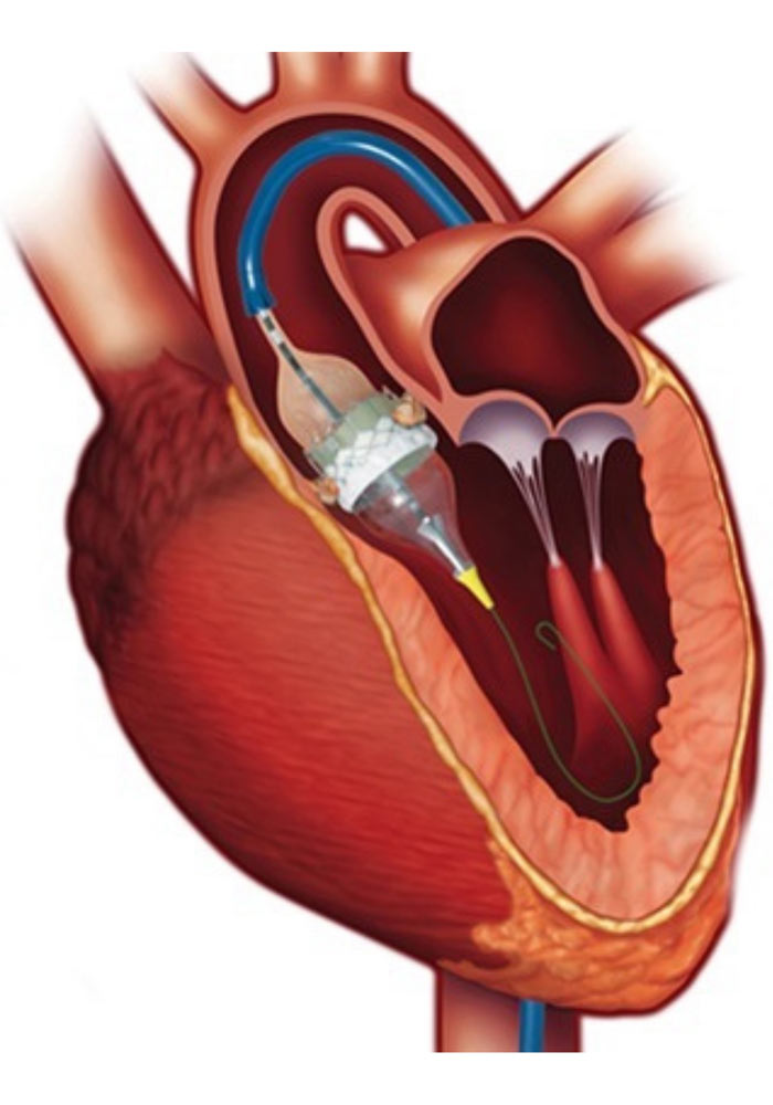 Αναίμακτη επέμβαση αορτικής βαλβίδας με τη μέθοδο TAVI  στο Ερρίκος Ντυνάν