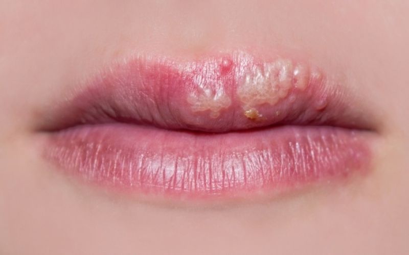 Η παρουσία των ιών HPV στο στόμα: Πρόληψη – Θεραπεία
