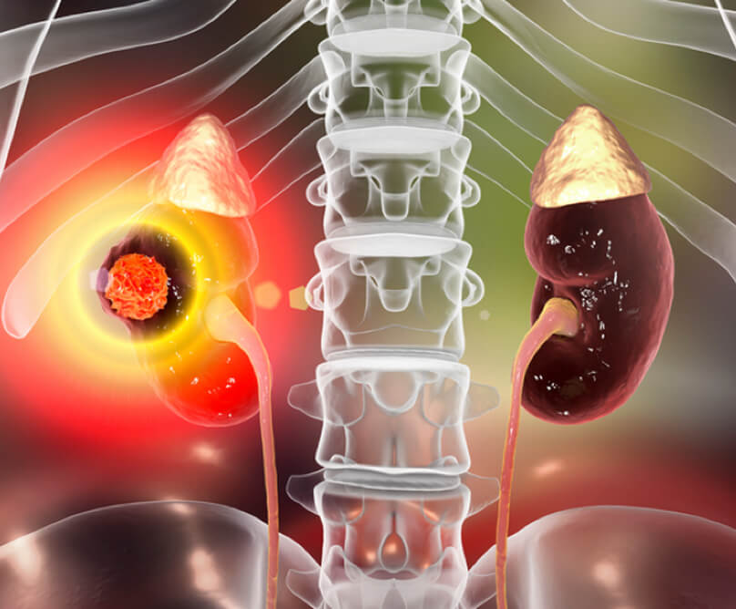 Καρκίνος του νεφρού: Ένας σιωπηλός εχθρός