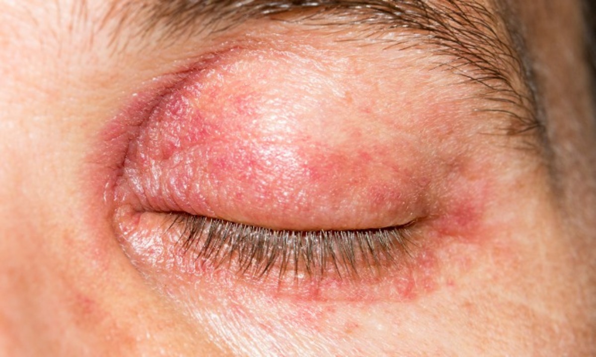 Έρπης ζωστήρ στο μάτι: Συμπτώματα και αντιμετώπιση