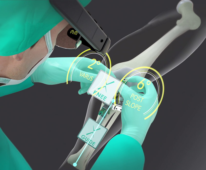 Το πιo σύγχρονο σύστημα επαυξημένης πραγματικότητας (augmented reality) για ολική αρθροπλαστική γόνατος