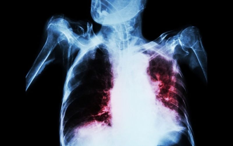 Ο κορωνοϊός ευθύνεται για την αύξηση των θανάτων από φυματίωση