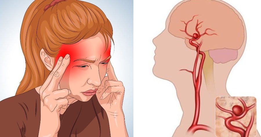 Ανεύρυσμα στο κεφάλι: Πώς θα αναγνωρίσετε τη ρήξη πριν να είναι πολύ αργά