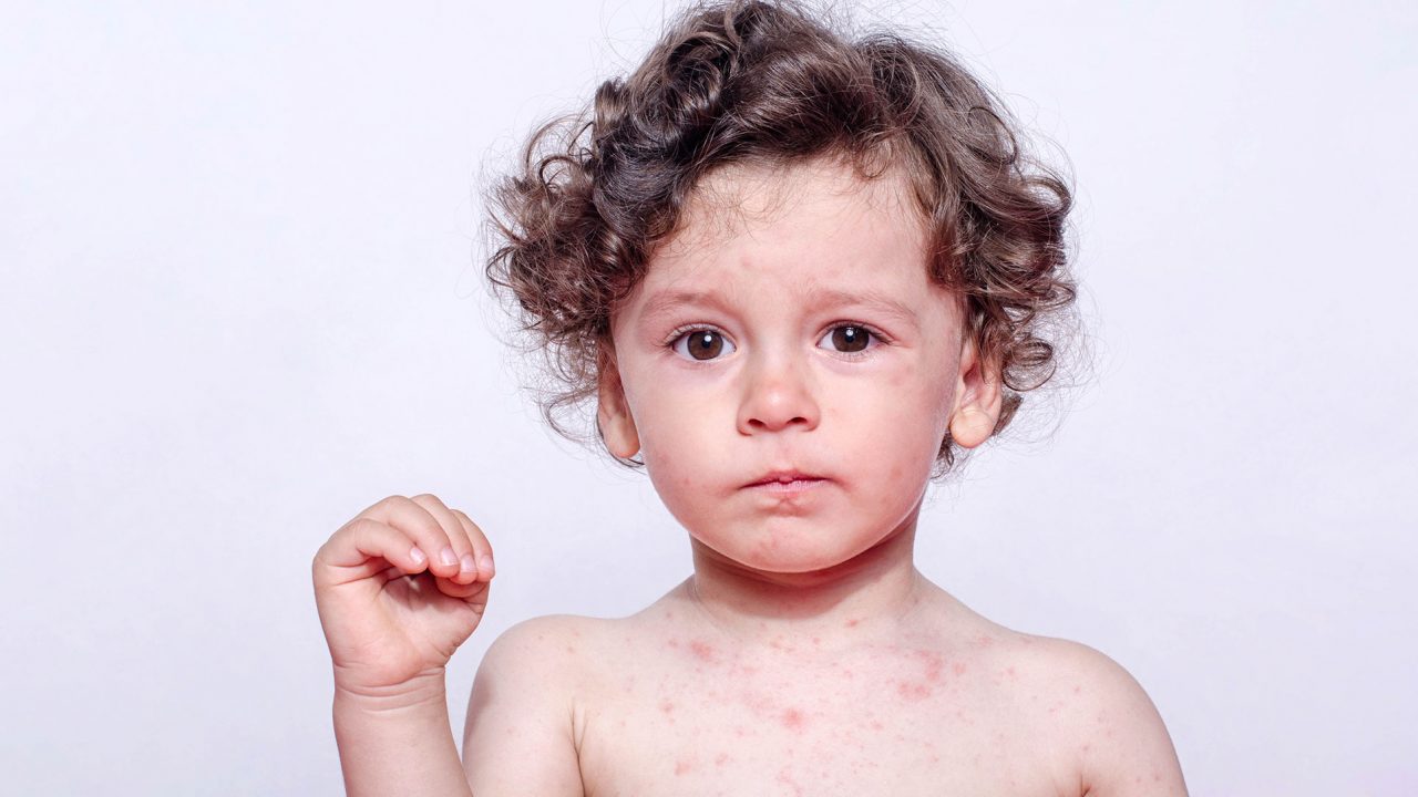 ΠΟΥ: Φόβος για εξάρσεις ιλαράς λόγω COVID