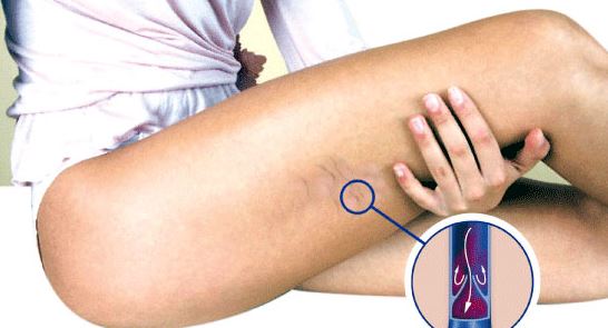 Φλεβική θρόμβωση: 6 πρώιμα σημάδια στο πόδι που πρέπει να σας ανησυχήσουν