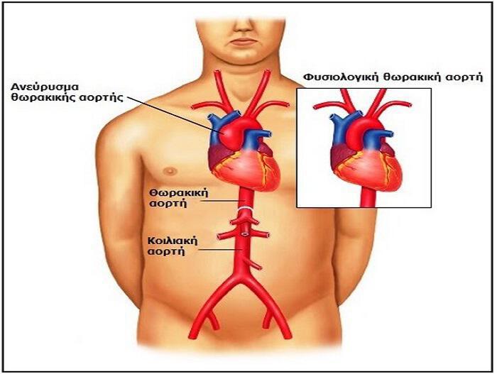 Ρήξη κοιλιακής αορτής: Στο 90% φτάνει η θνησιμότητα