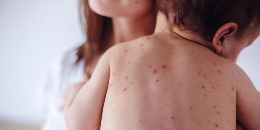 Φόβοι για παγκόσμια έξαρση της ιλαράς καθώς η πανδημία COVID-19 έχει διαταράξει τους παιδικούς εμβολιασμούς