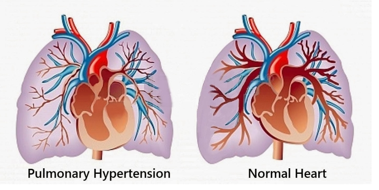 Πνευμονική Υπέρταση: Αίτια – Συμπτώματα- Θεραπεία