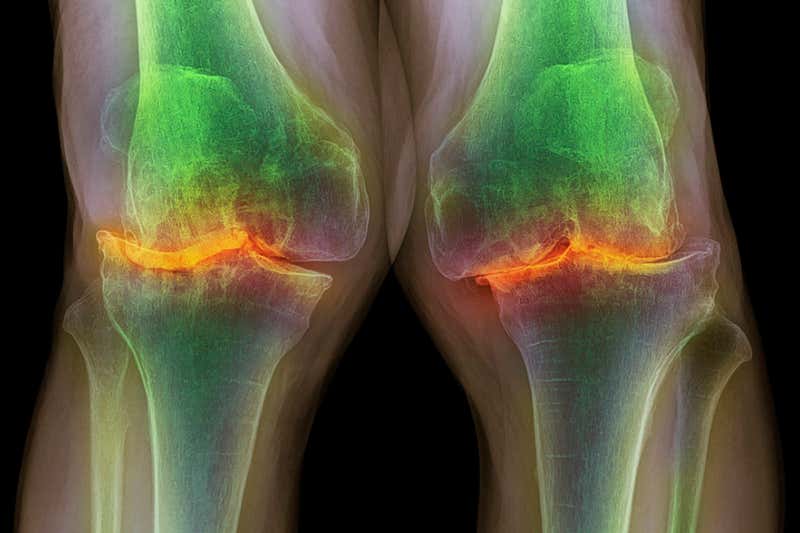 Τα ηλεκτρικά εμφυτεύματα γόνατος θα μπορούσαν να βοηθήσουν στη θεραπεία του πόνου της οστεοαρθρίτιδας
