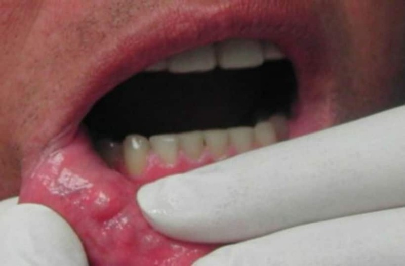 Νέα δεδομένα στην πρόληψη και έγκαιρη διάγνωση του καρκίνου του στόματος
