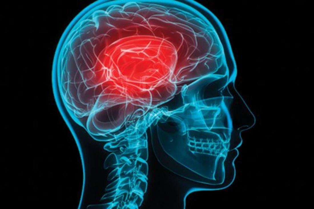Ειδική Μονάδα για εγκεφαλικά στο «Παπανικολάου» – Τα συμπτώματα και τι πρέπει να κάνετε