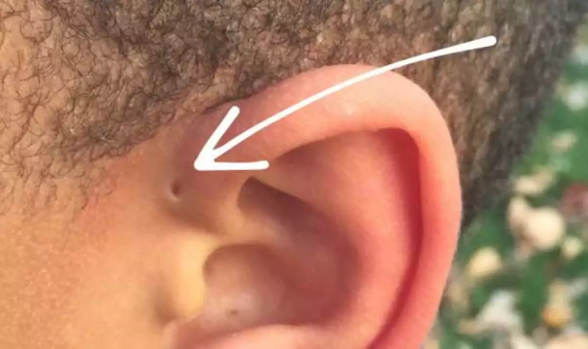 Προωτικός κολπίσκος: Τι είναι η μικροσκοπική τρύπα πάνω από το αυτί που έχουν κάποιοι;