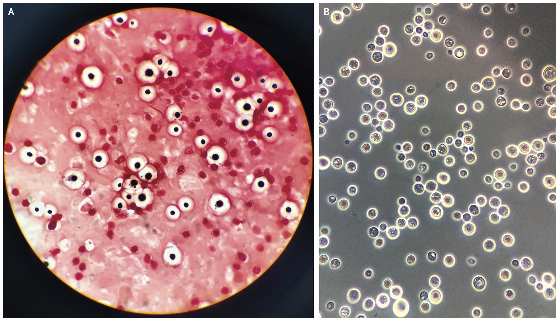 Νέα μελέτη: Ο μύκητας Cryptococcus neoformans αναπτύσσει αντοχή στα αντιμυκητιακά φάρμακα