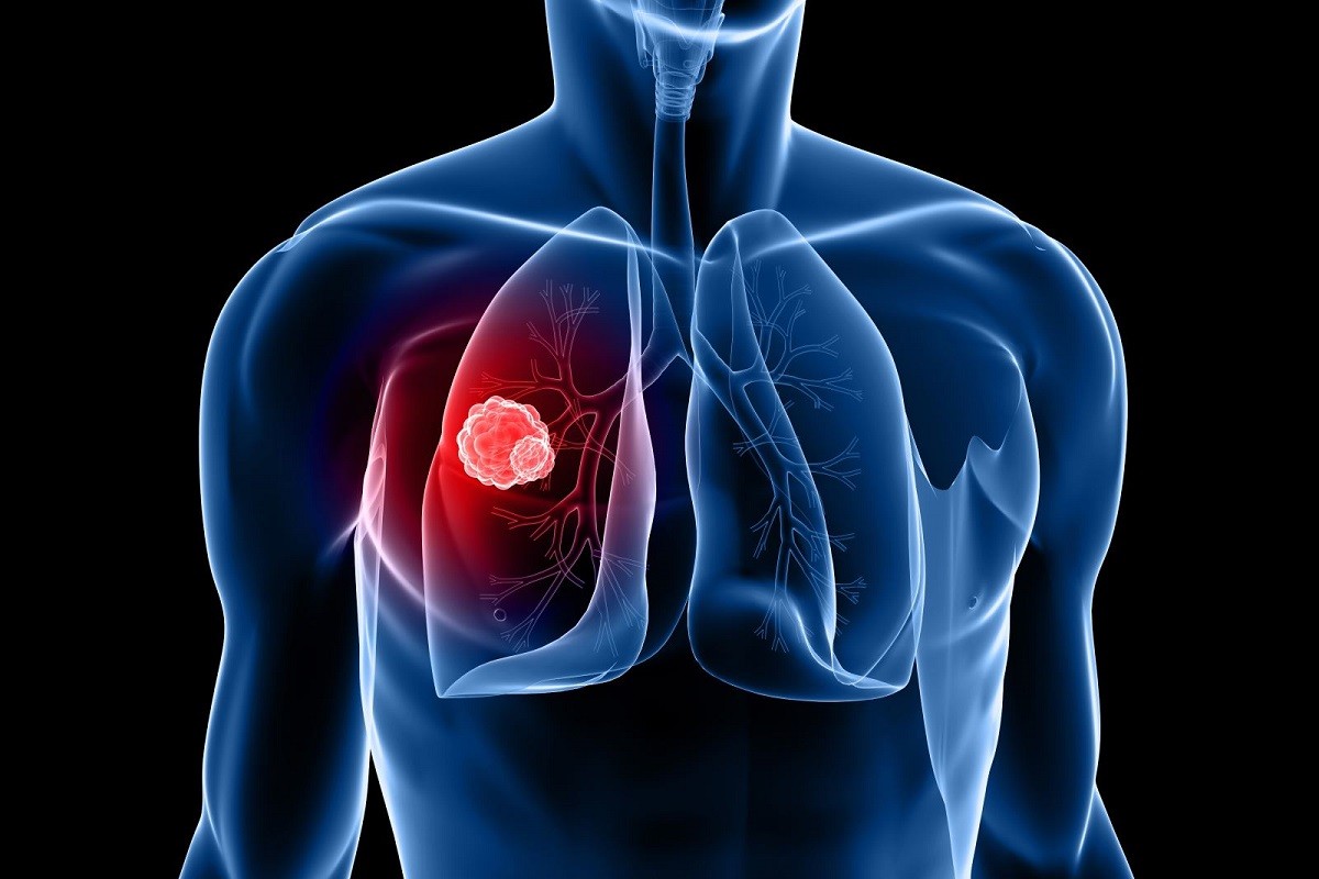 «Αν αυτός ο βήχας έχει γίνει μέρος της ζωής σας, ελέγξετε το»: Αφίσες προειδοποιούν για τα συμπτώματα του καρκίνου του πνεύμονα