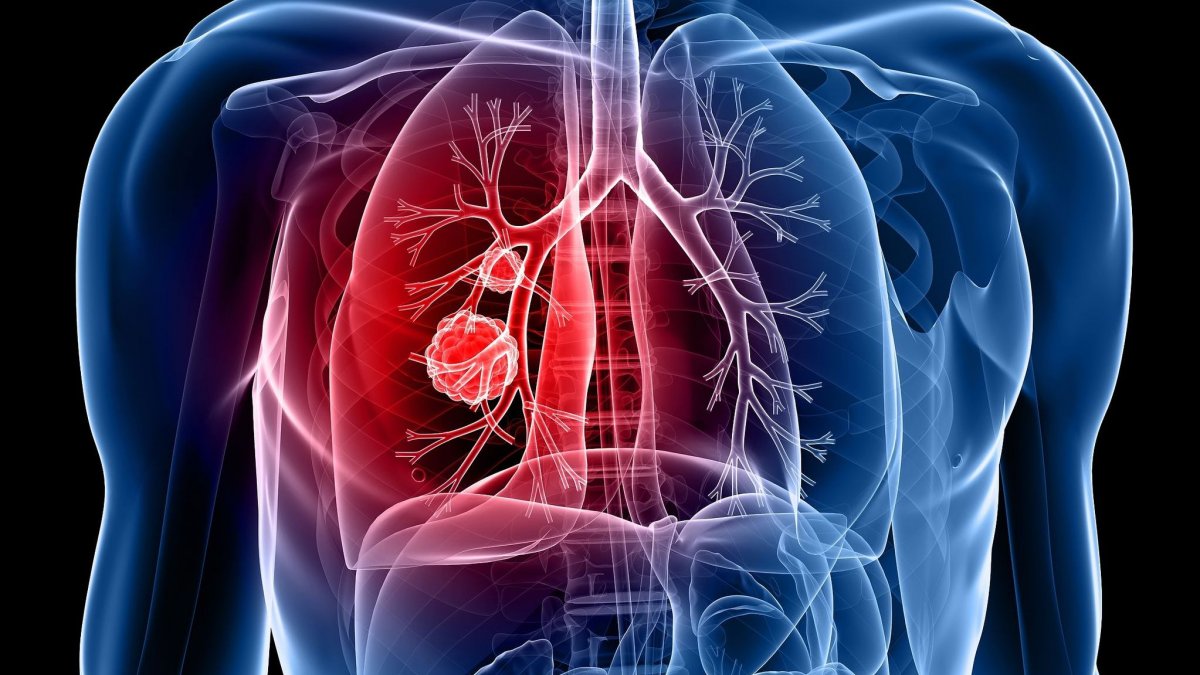 Καρκίνος του πνεύμονα: Δείτε ποια είναι τα συμπτώματα ανάλογα με το στάδιο