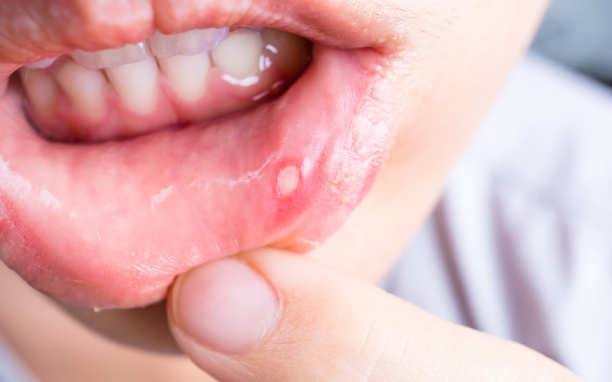 Καρκίνος του στόματος: Αυτά είναι τα πρώτα σημάδια που πρέπει να έχετε στο νου σας