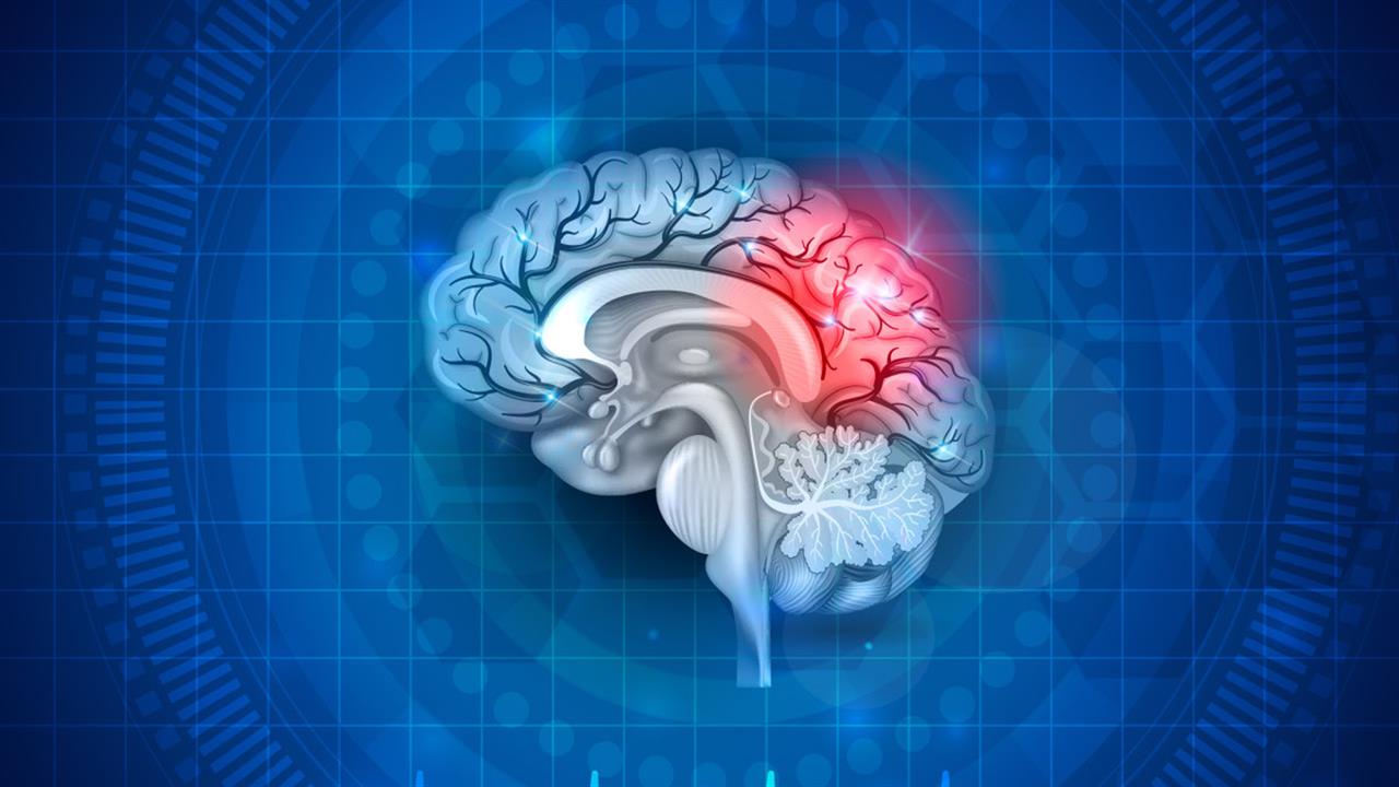 Νέα έρευνα: Όσοι πάσχουν από ημικρανία διατρέχουν αυξημένο κίνδυνο ισχαιμικού εγκεφαλικού επεισοδίου
