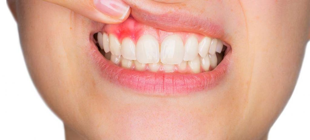 Ασθένεια των ούλων: Πώς συνδέεται με την υγεία του καρδιαγγειακού συστήματος